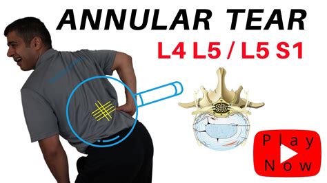 annular ligament tear test|bulging disc annular tear treatment.